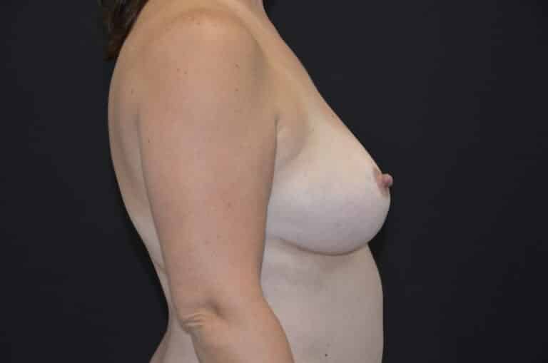 After Image: Breast Reduction - right-side