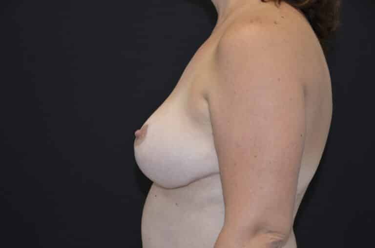 After Image: Breast Reduction - left-side