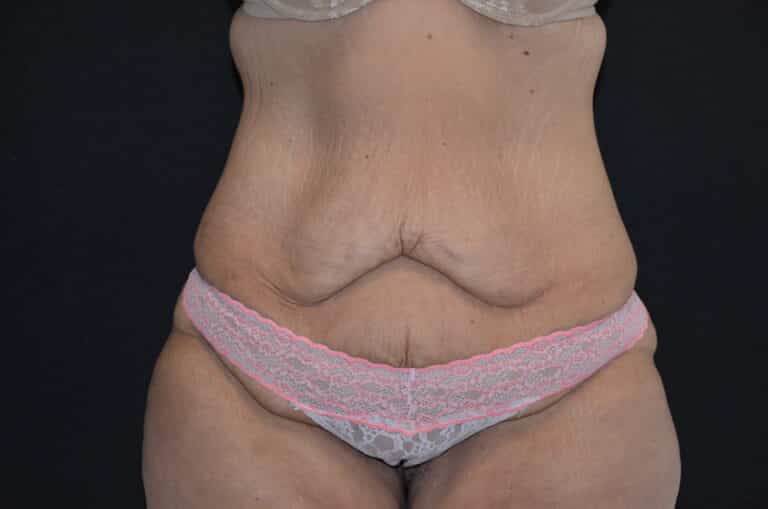 Before Image: Tummy Tuck - front