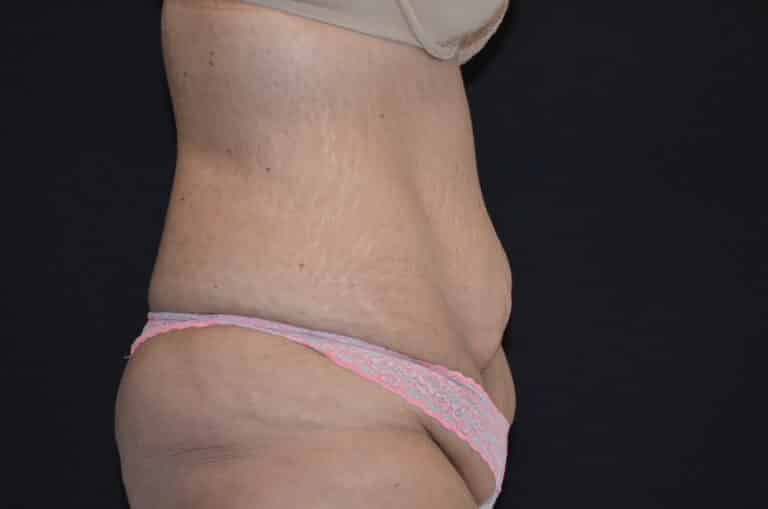 Before Image: Tummy Tuck - right-side