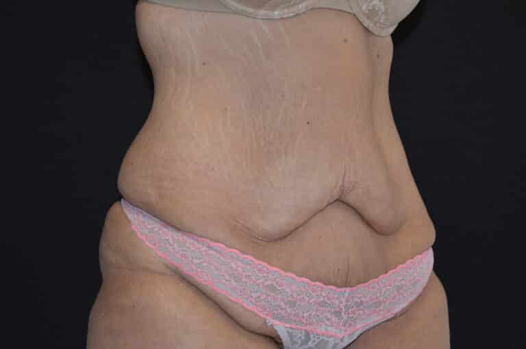 Before Image: Tummy Tuck - right-front-oblique