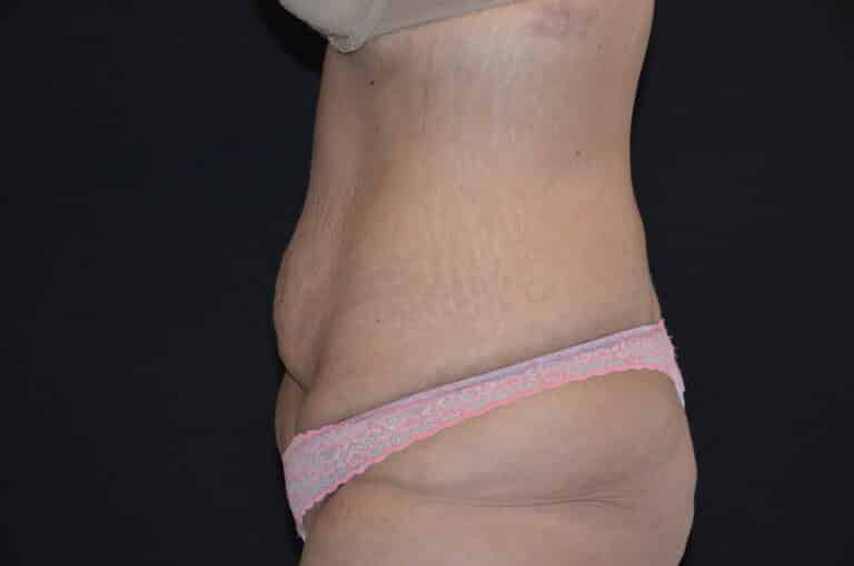 Before Image: Tummy Tuck - left-side