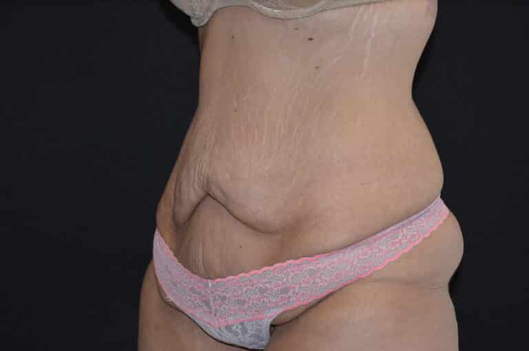 Before Image: Tummy Tuck - left-front-oblique