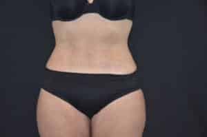 After Image: Tummy Tuck