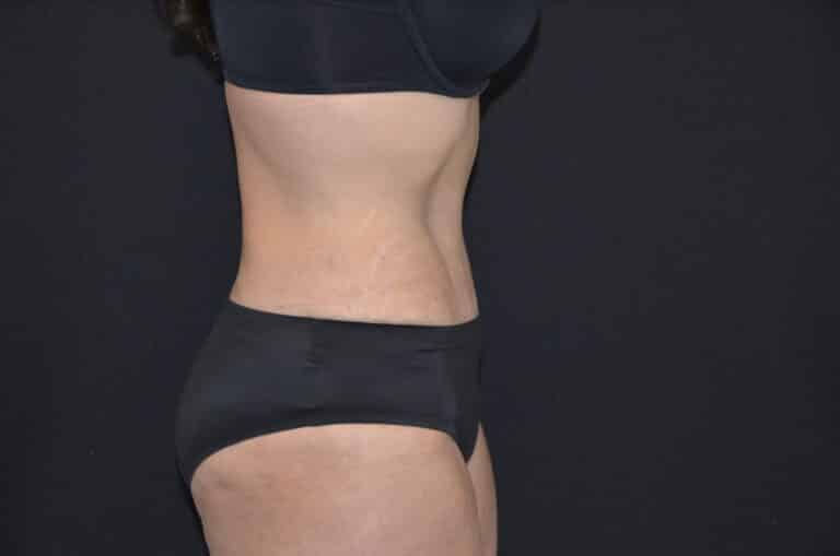 After Image: Tummy Tuck - right-side