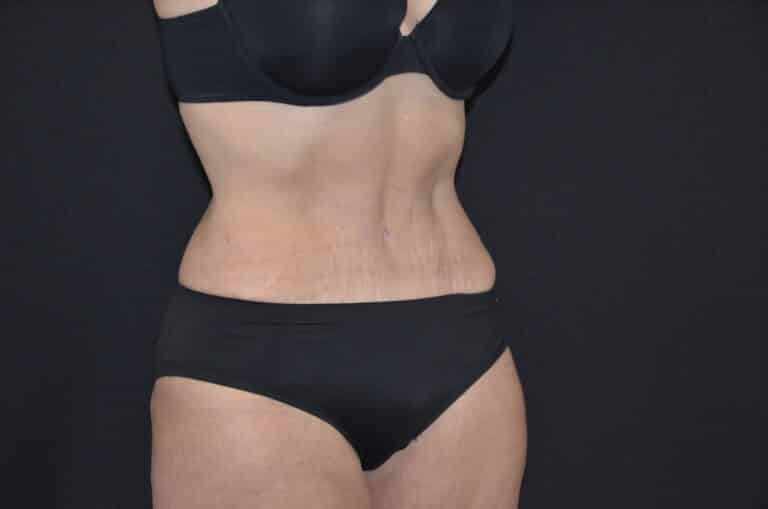 After Image: Tummy Tuck - right-front-oblique