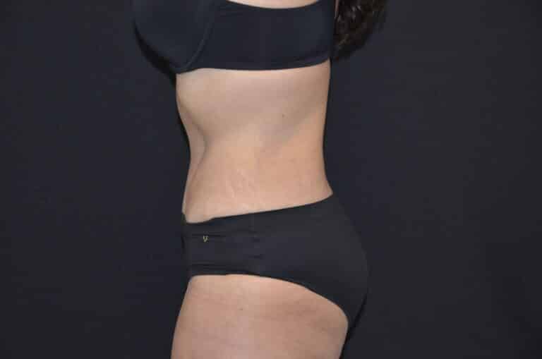 After Image: Tummy Tuck - left-side