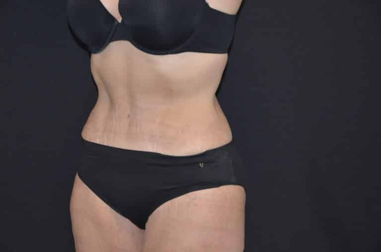 After Image: Tummy Tuck - left-front-oblique