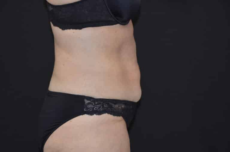 Before Image: Tummy Tuck - right-side