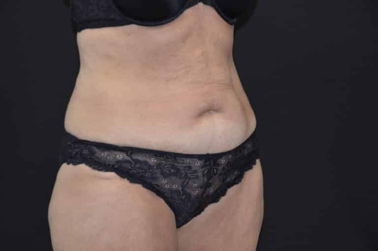 Before Image: Tummy Tuck - right-front-oblique