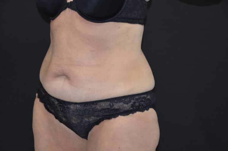 Before Image: Tummy Tuck - left-front-oblique