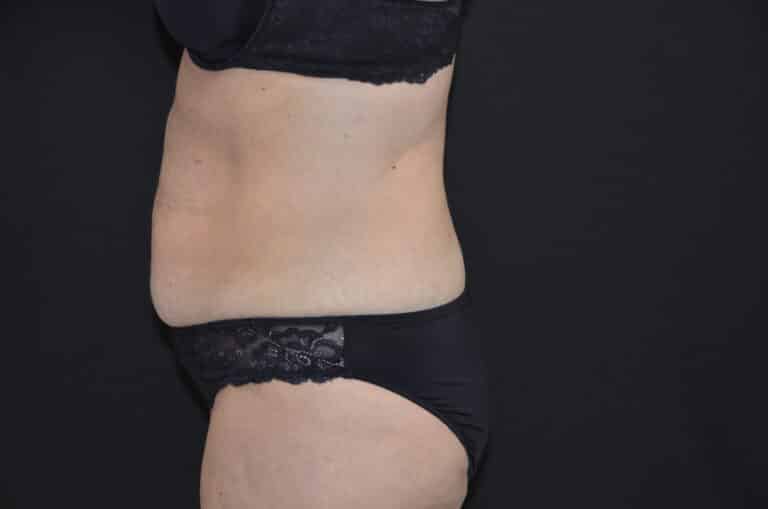 Before Image: Tummy Tuck - left-side