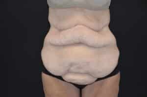 Before Image: Tummy Tuck