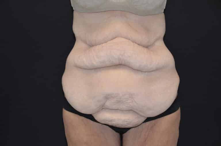 Before Image: Tummy Tuck - front