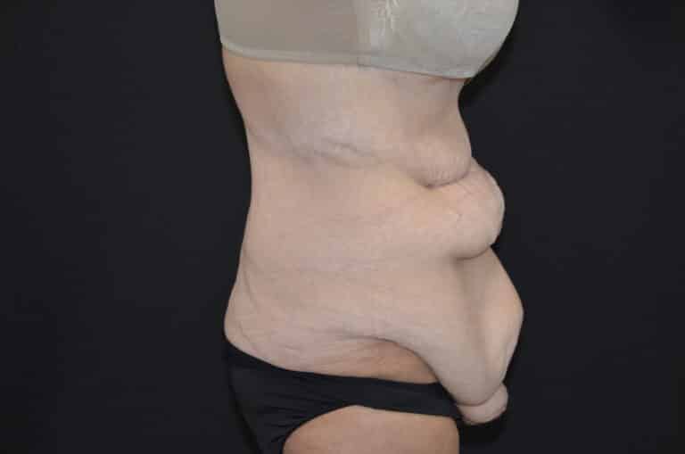 Before Image: Tummy Tuck - right-side