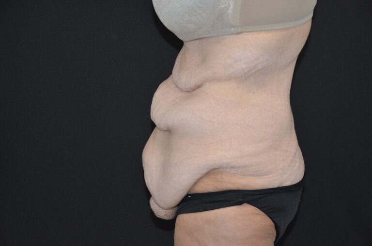 Before Image: Tummy Tuck - left-side