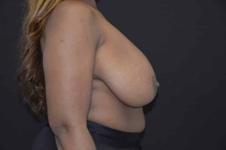 Before Image: Breast Reduction - right-side