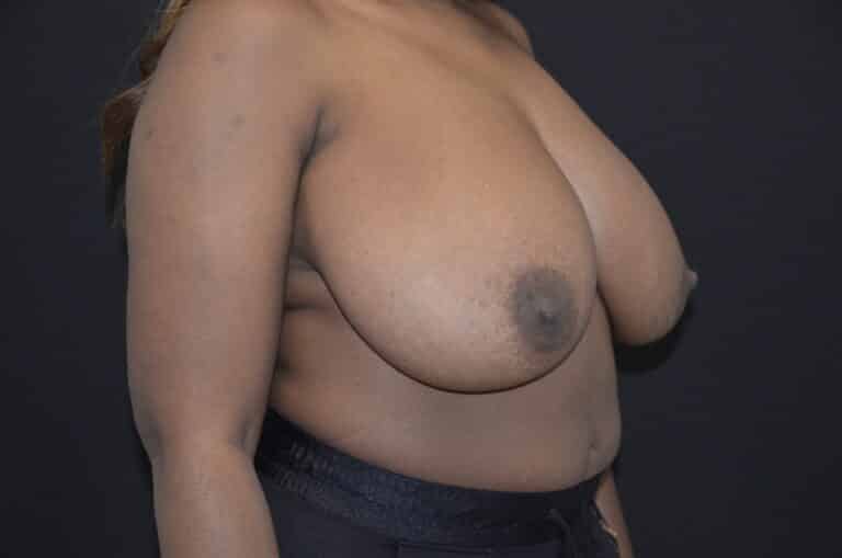 Before Image: Breast Reduction - right-front-oblique