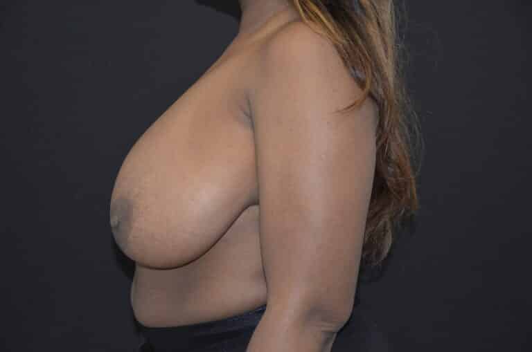 Before Image: Breast Reduction - left-side