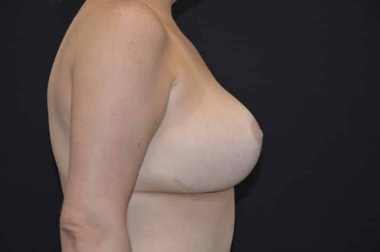 After Image: Breast Lift with Implants - right-side