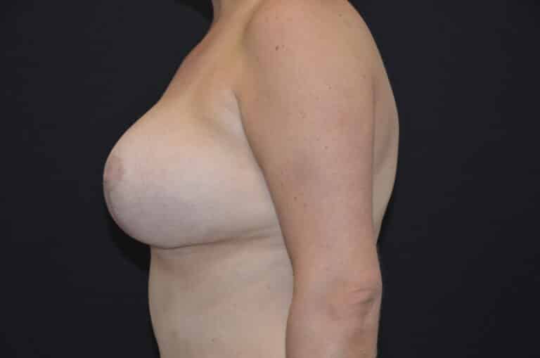 After Image: Breast Lift with Implants - left-side