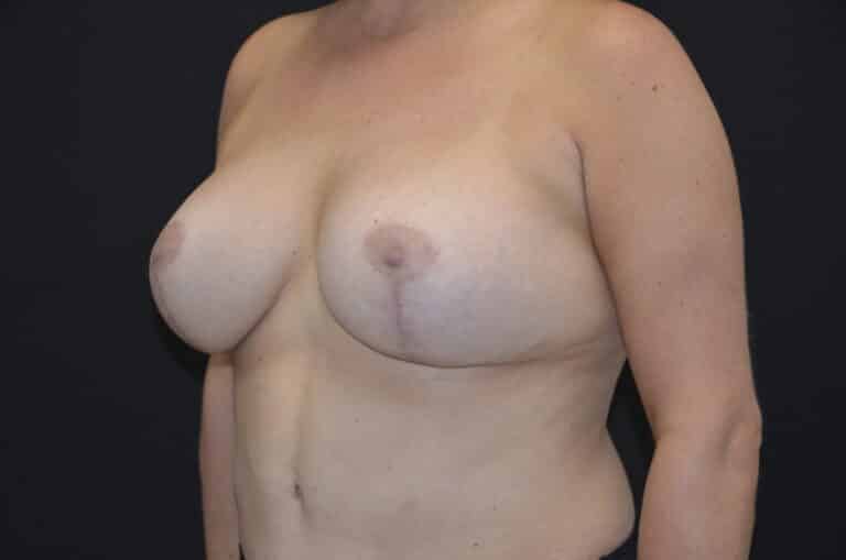 After Image: Breast Lift with Implants - left-front-oblique