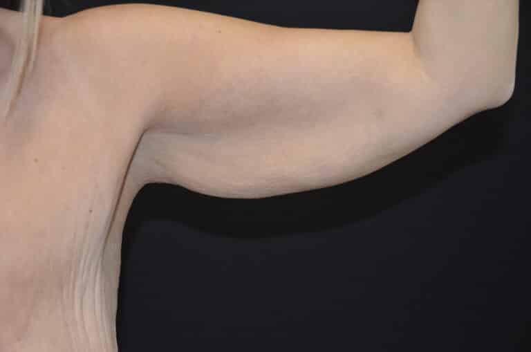 Before Image: Brachioplasty - front