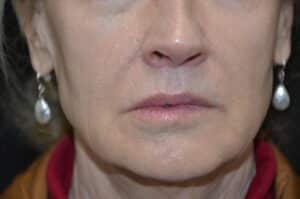 After Image: Lip Lift