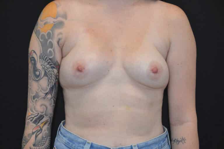 Before Image: Breast Augmentation - front