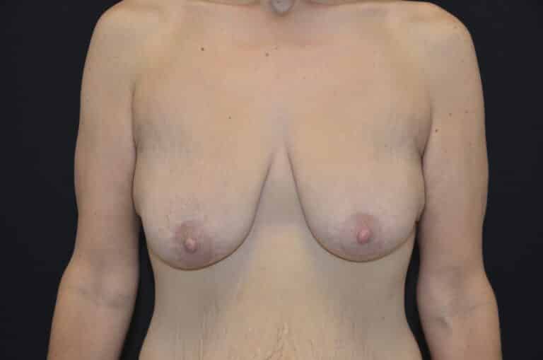 Before Image: Breast Lift - front