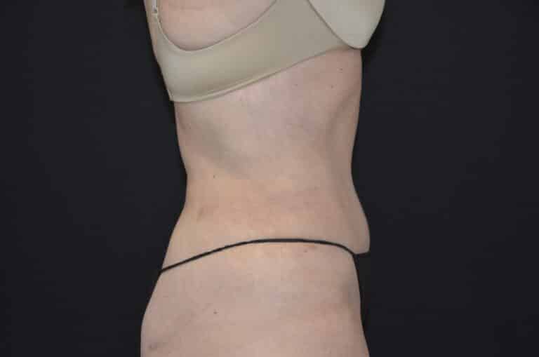 After Image: Tummy Tuck - right-side