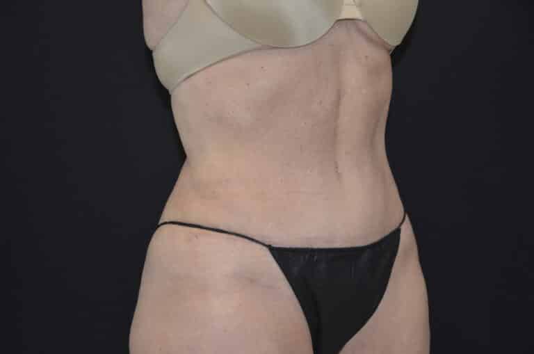 After Image: Tummy Tuck - right-front-oblique