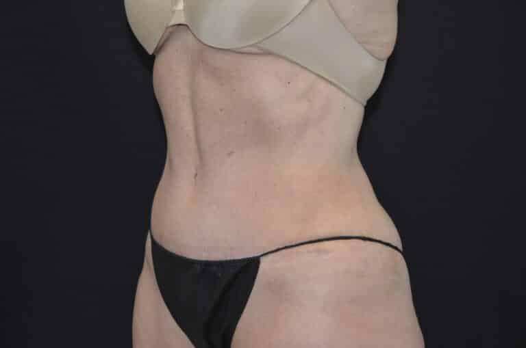 After Image: Tummy Tuck - left-front-oblique