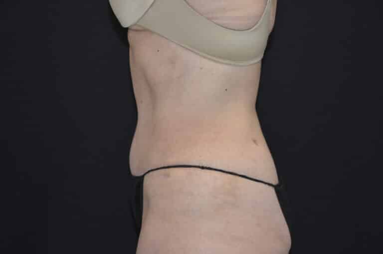 After Image: Tummy Tuck - left-side