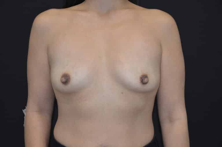 Before Image: Breast Augmentation - front