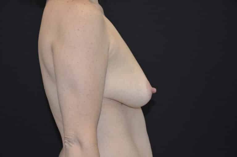 Before Image: Breast Lift - right-side