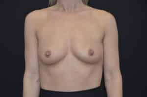 Before Image: Breast Augmentation