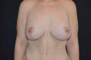 After Image: Breast Lift with Implants