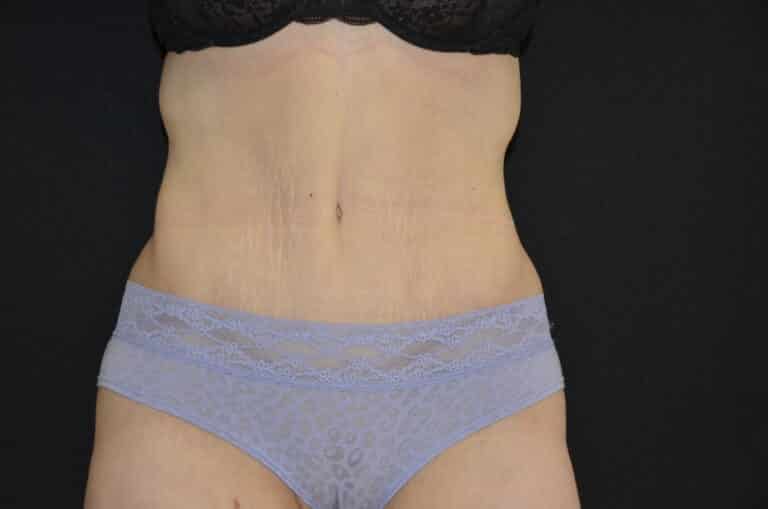 After Image: Tummy Tuck - front