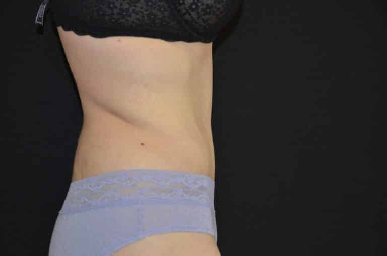 After Image: Tummy Tuck - right-side