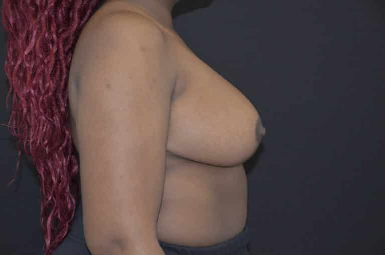 After Image: Breast Reduction - right-side