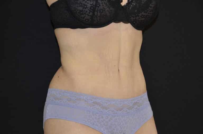 After Image: Tummy Tuck - right-front-oblique