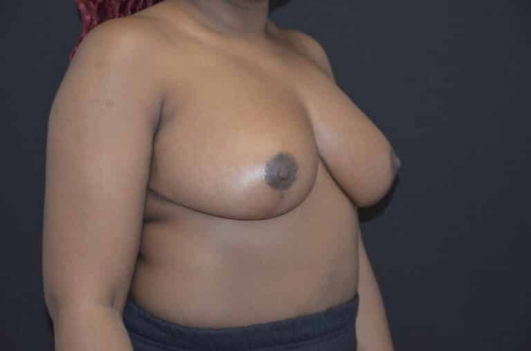 After Image: Breast Reduction - right-front-oblique