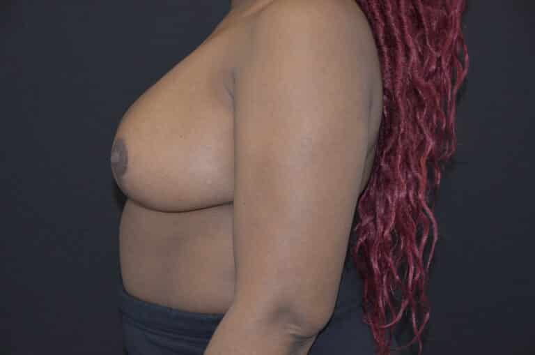 After Image: Breast Reduction - left-side