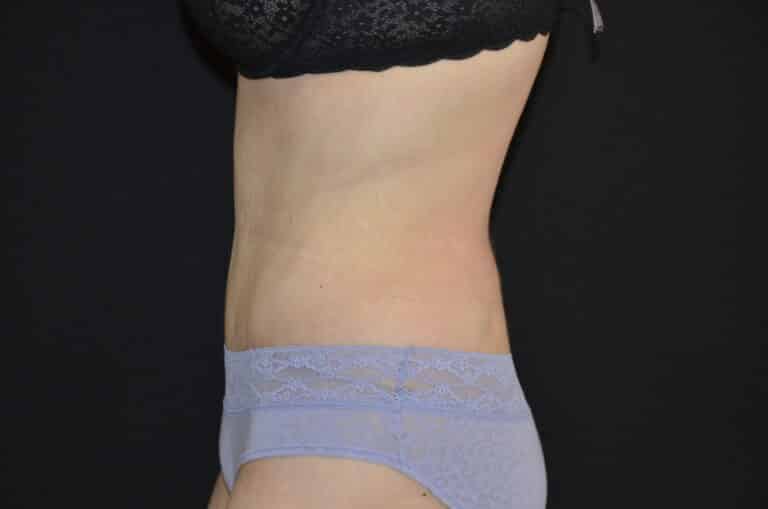 After Image: Tummy Tuck - left-side