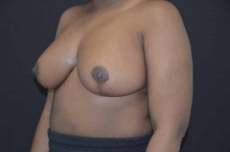 After Image: Breast Reduction - left-front-oblique