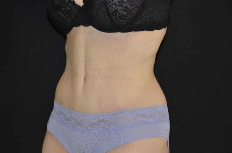 After Image: Tummy Tuck - left-front-oblique