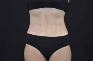 After Image: Tummy Tuck