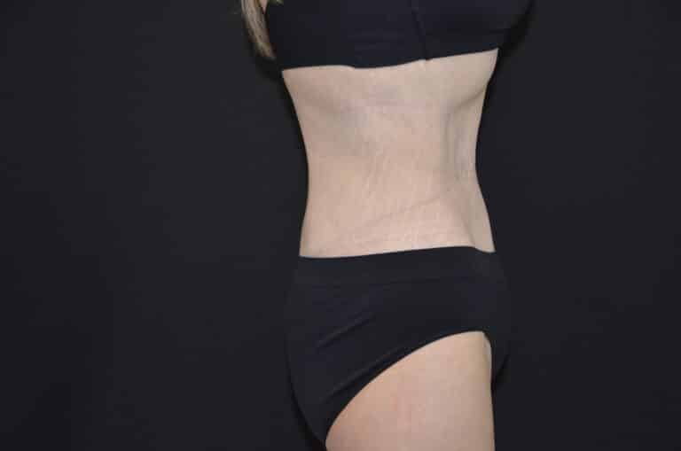 After Image: Tummy Tuck - right-side