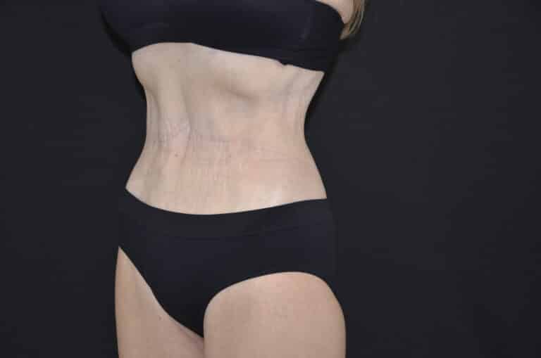 After Image: Tummy Tuck - left-front-oblique